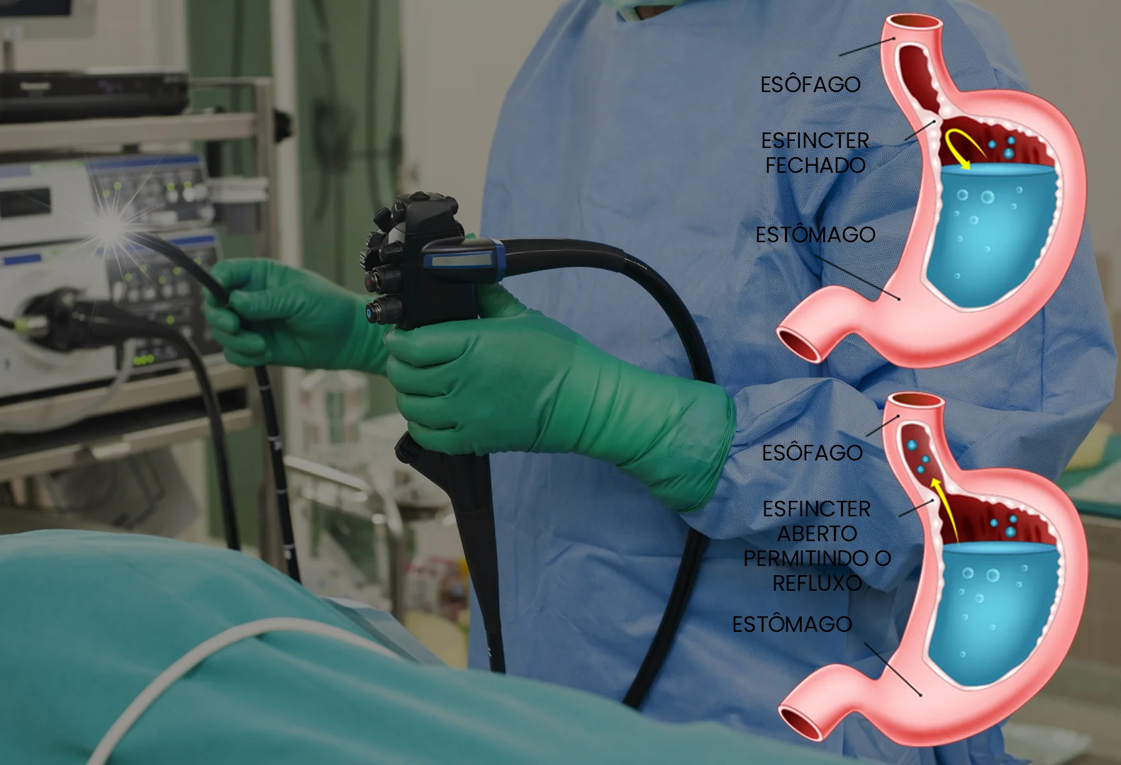 Cirurgia de refluxo gastroesofágico