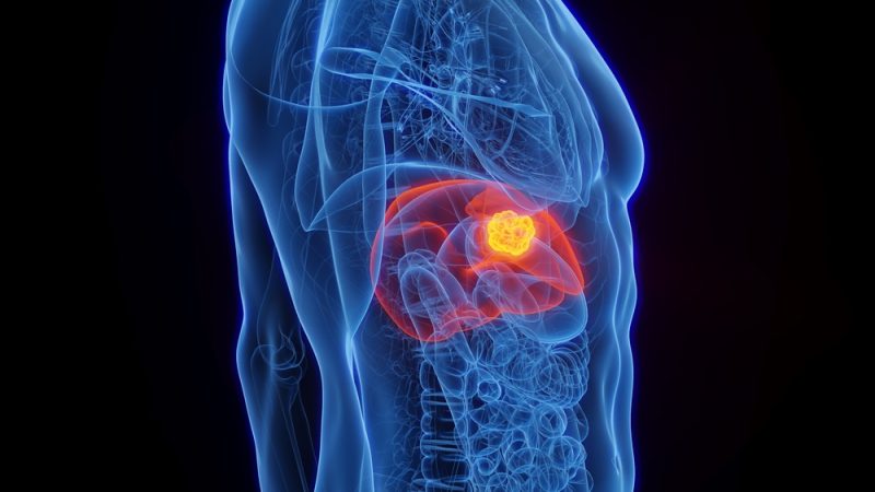 Tumores do fígado e vias biliares