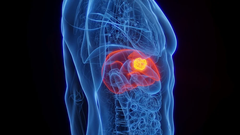 Tumores do fígado e vias biliares