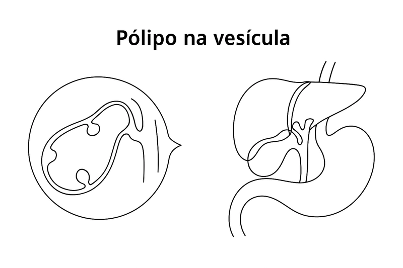 Pólipos na vesícula: o que são e como tratar