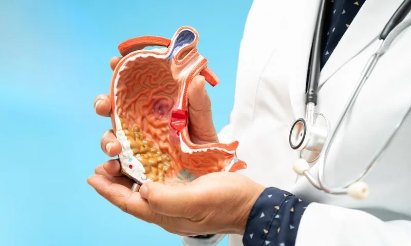 Úlcera gástrica: quando a intervenção cirúrgica é necessária?