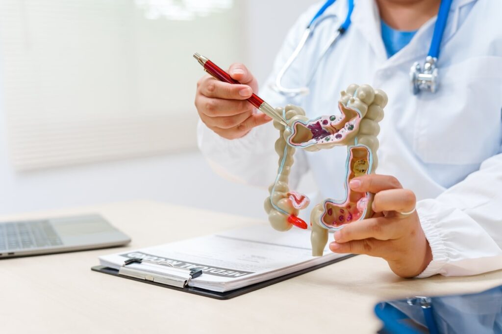 Polipose adenomatosa familiar e câncer de intestino