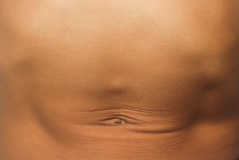 Hérnia femoral: sintomas, causas e tratamentos eficazes