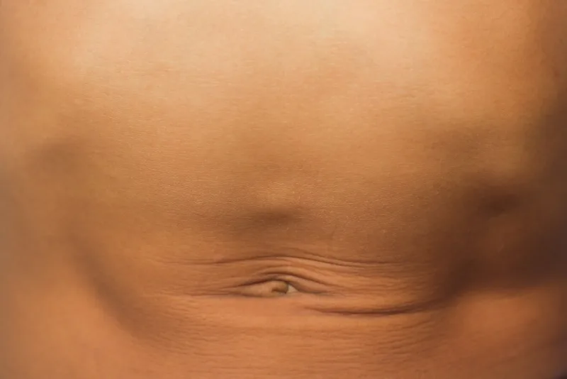 Hérnia femoral: sintomas, causas e tratamentos eficazes