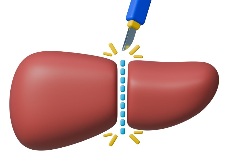 Hepatectomia: o que é, tipos e cuidados essenciais