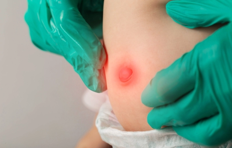 Tratamento para hérnia umbilical: como é realizado?